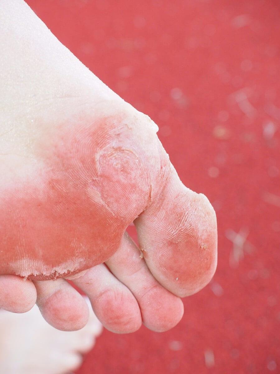 Burning Feet from Gout