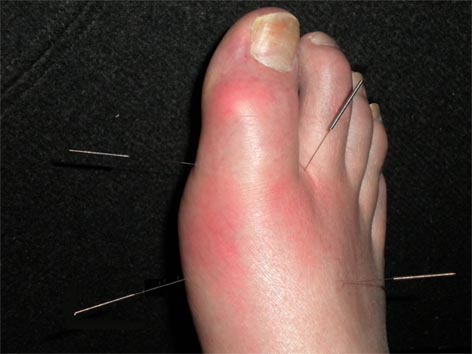 Acupuncture For Gout Photograph
